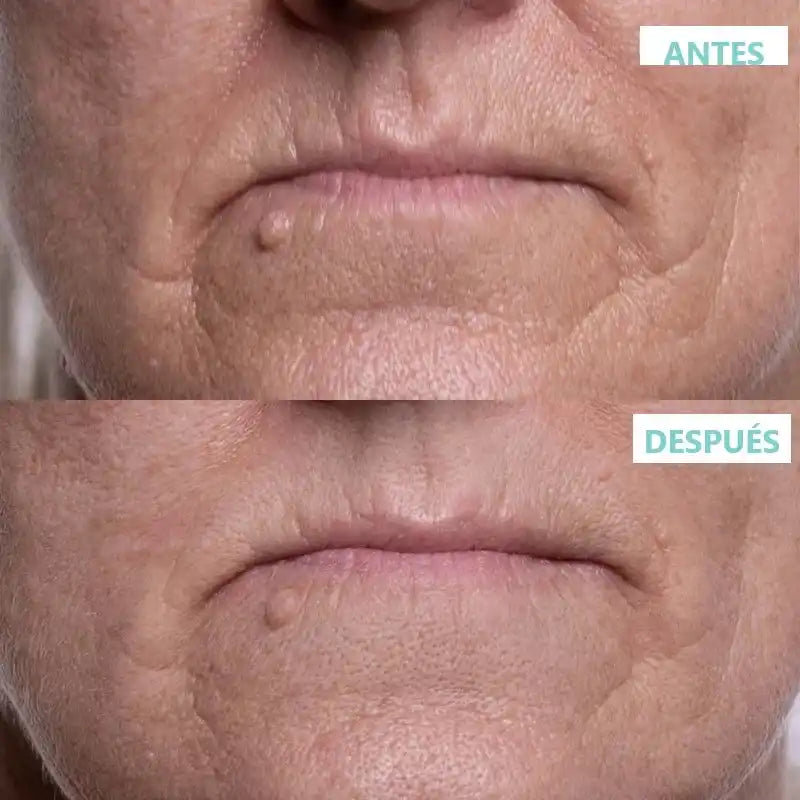 LisoDerm - kit con 16 parches
